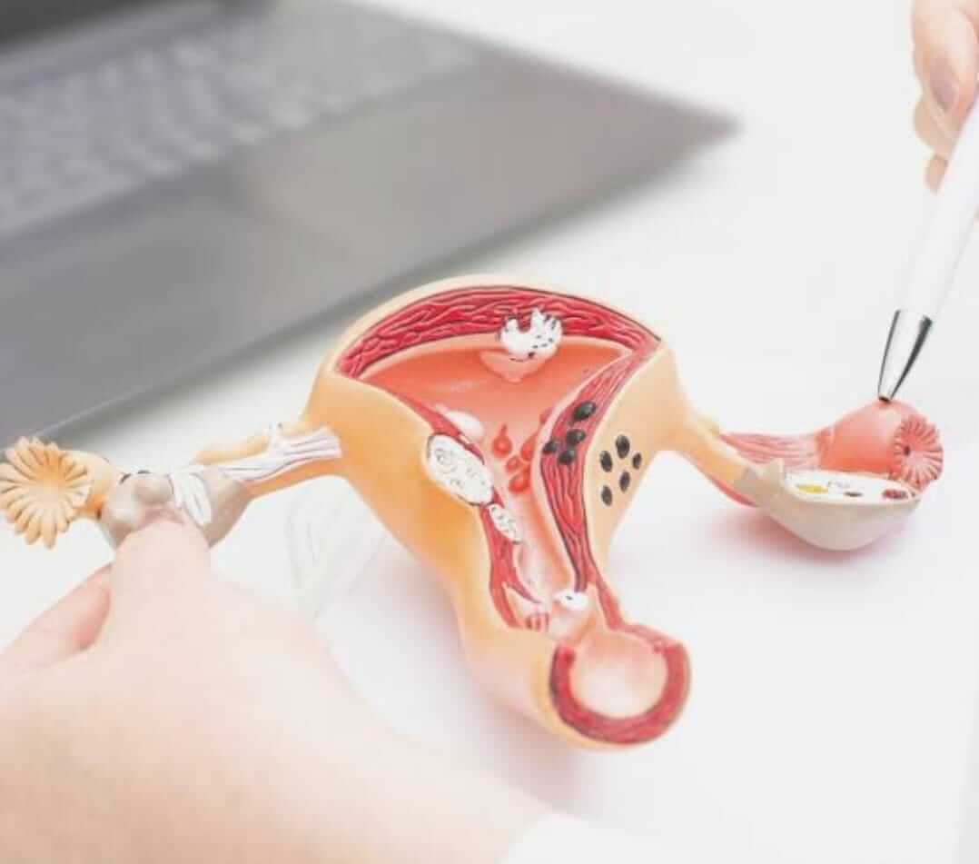 Cisto no ovário: o que é, sintomas, tipos e tratamento - Cistos no Ovário Londrina 