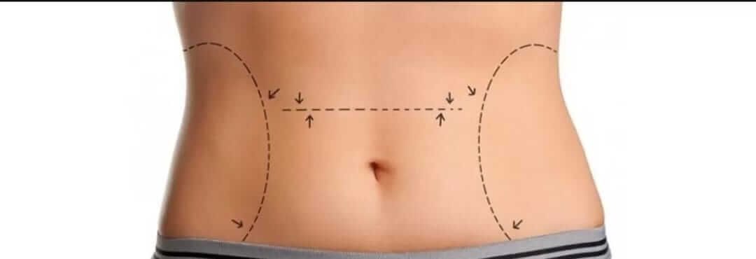 Abdominoplastia: Saiba tudo sobre esse procedimento - Abdominoplastia Londrina