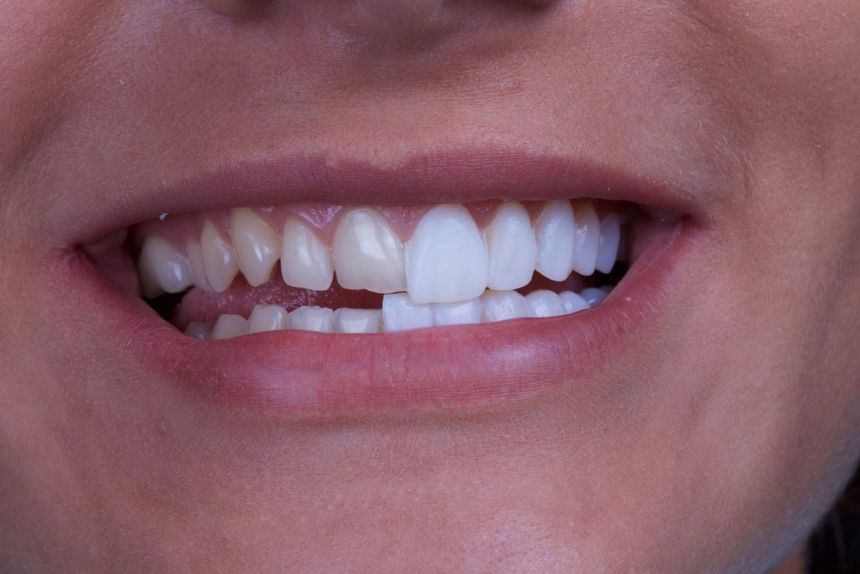 Tratamento com Lentes de Contato Dental em Maringá: Guia Completo