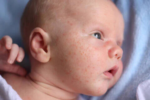 O que causa a acne infantil? - Dermatologista Londrina