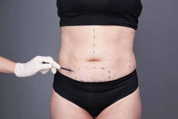 Em que consiste a abdominoplastia? - Especialistas Em Abdominoplastia Joinville