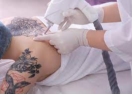 Remoção de Tatuagem: O que todo paciente deveria saber - Remoção de Tatuagem Maringá