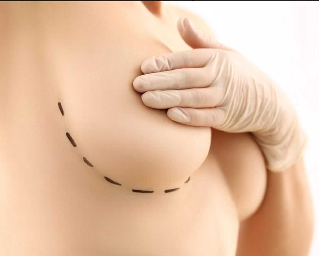 Mamoplastia de Aumento - Mamoplastia Londrina