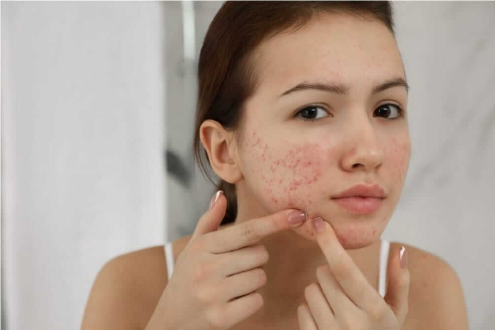 O que fazer para eliminar a acne? - Dermatologista Joinville