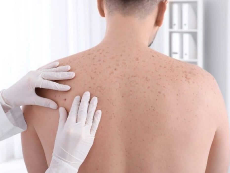 Quais são os primeiros sinais do câncer de pele? - Dermatologista Joinville