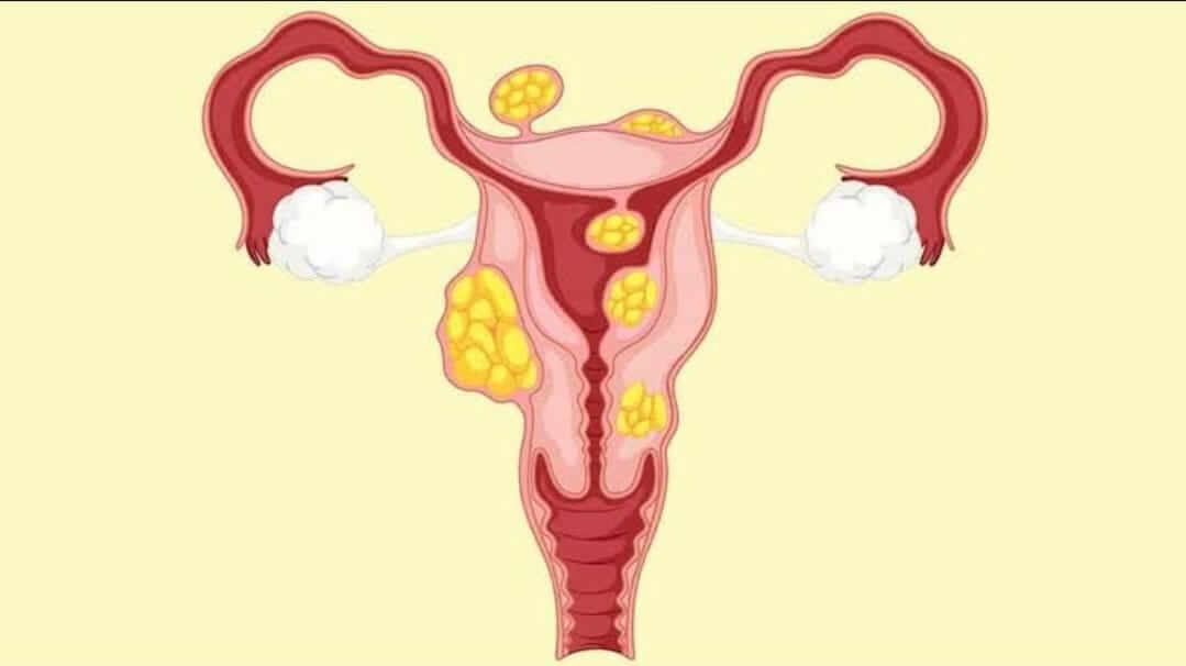 O que é o mioma uterino e quando devo me preocupar? - Mioma Uterino Londrina