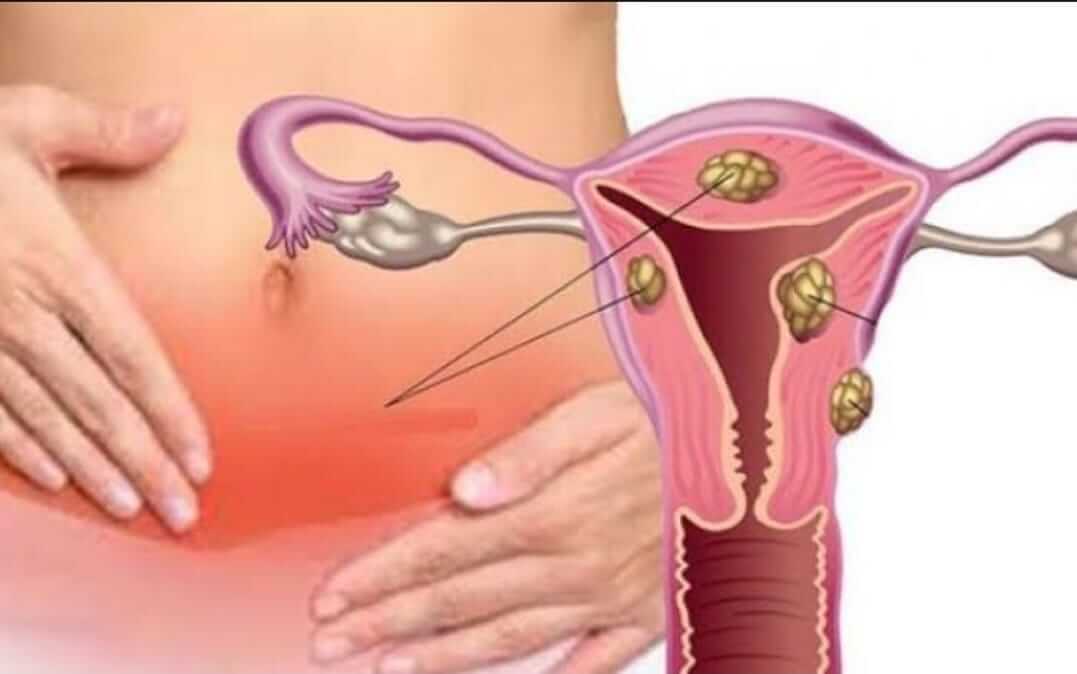 Mioma uterino: o que é, quais seus sintomas e tratamento? - Mioma Uterino Niterói