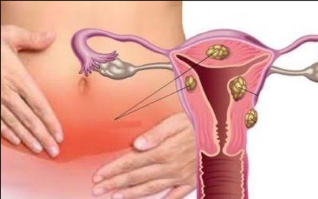 Mioma no útero é sinal de câncer? - Mioma Uterino Florianópolis