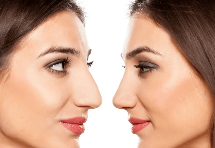Quanto tempo dura uma harmonização no rosto? - Dermatologista Curitiba
