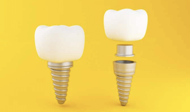 Implante Dentário Florianópolis