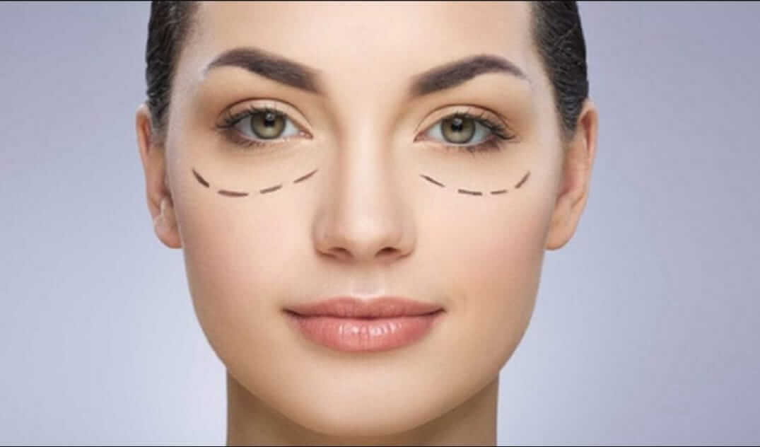 Blefaroplastia: Como o procedimento é realizado? - Blefaroplastia Uberlândia