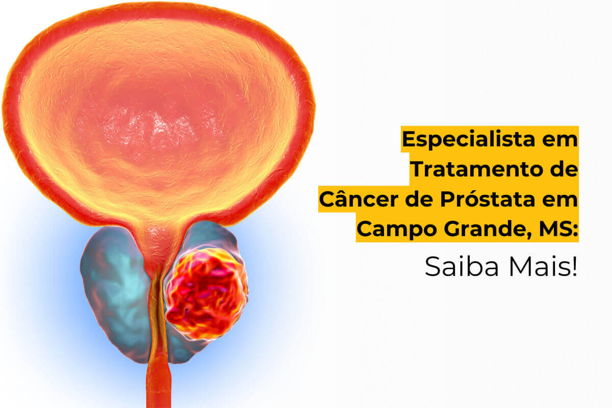 Especialista no Tratamento do Câncer de Próstata em Campo Grande: Conheça os Principais Tratamentos
