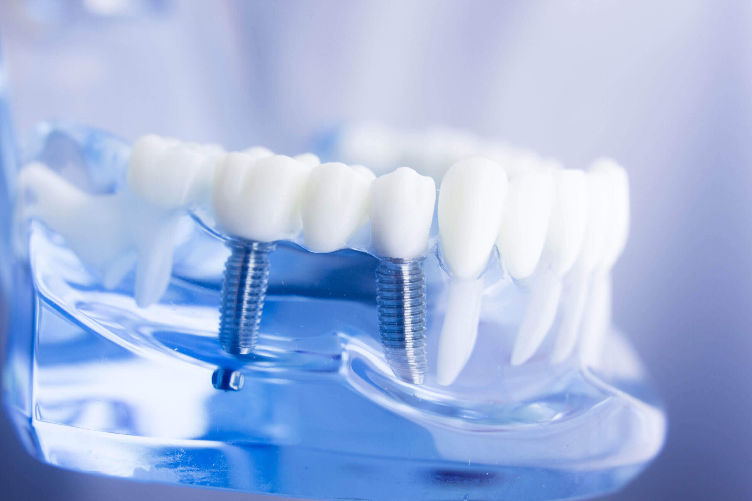 Implante Dentário em Maringá: Segurança e Benefícios dos Implantes, com os Especialistas da Guia Saúde