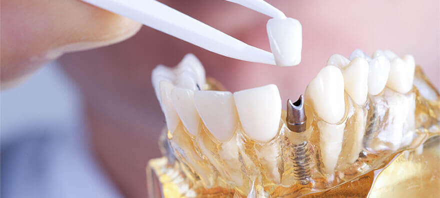 Implante Dentário em Maringá: Segurança e Benefícios dos Implantes, com os Especialistas da Guia Saúde