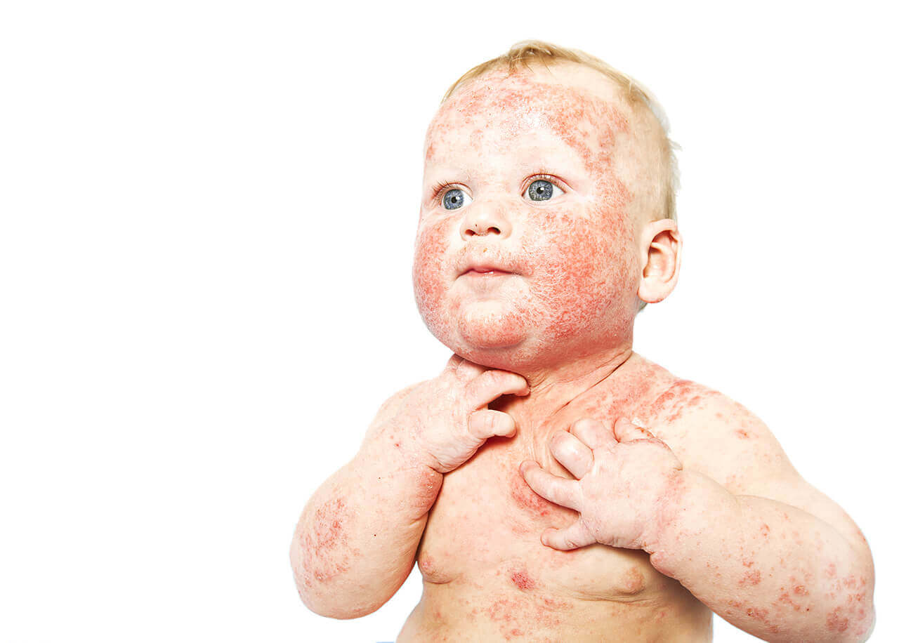 O que ativa a dermatite atópica? - Dermatologista Londrina