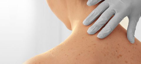 Câncer de pele: diagnóstico e tratamento da doença - Dermatologista Limeira