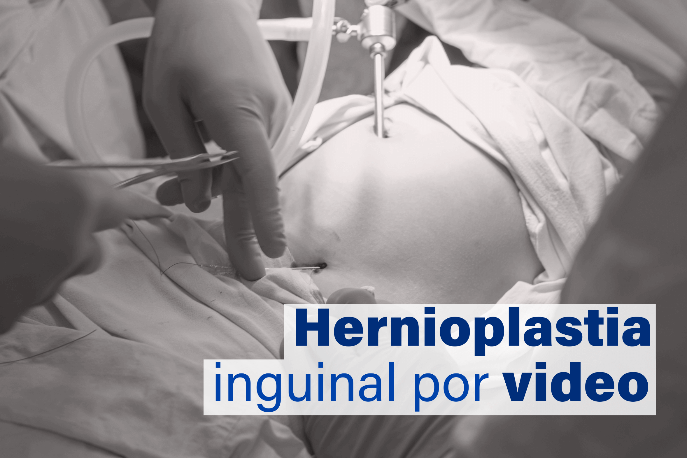 Como é feita a cirurgia de hérnia inguinal por video? - Cirurgia do Aparelho Digestivo Maringá