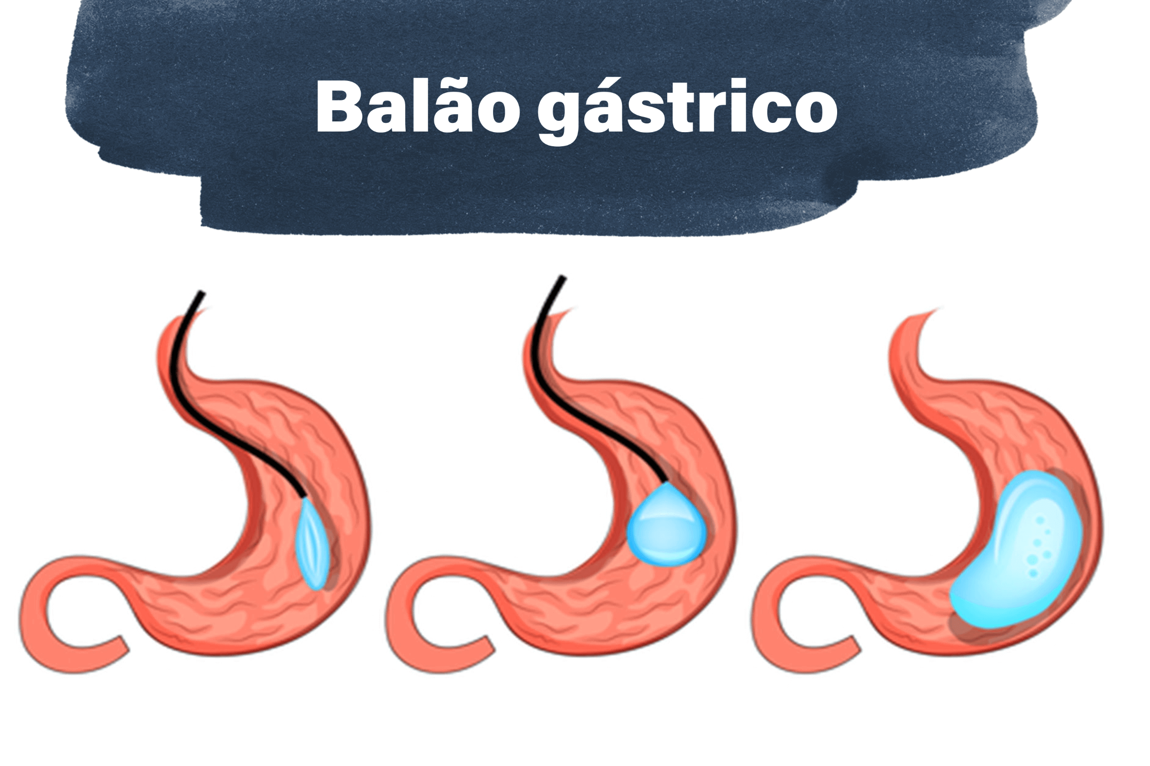 É possível emagrecer com balão gástrico? - Cirurgia do aparelho digestivo Maringá