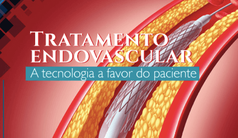 Tratamento Endovarcular - Maringá