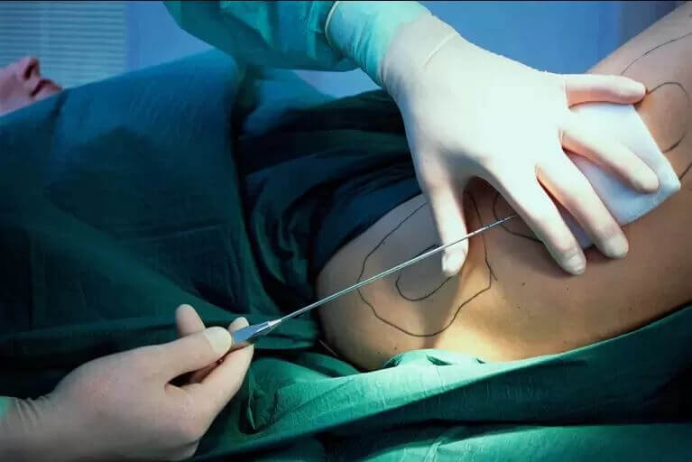 Lipoaspiração: onde encontrar um cirurgião plástico para realizar o procedimento?