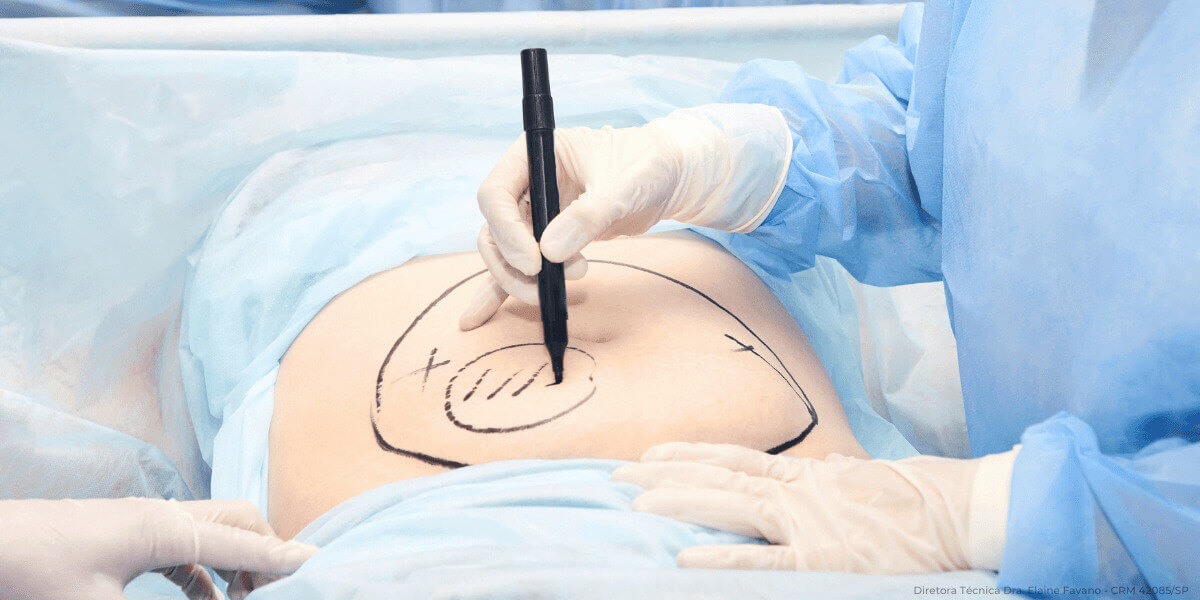 Abdominoplastia: onde encontrar um cirurgião plástico para realizar o procedimento?