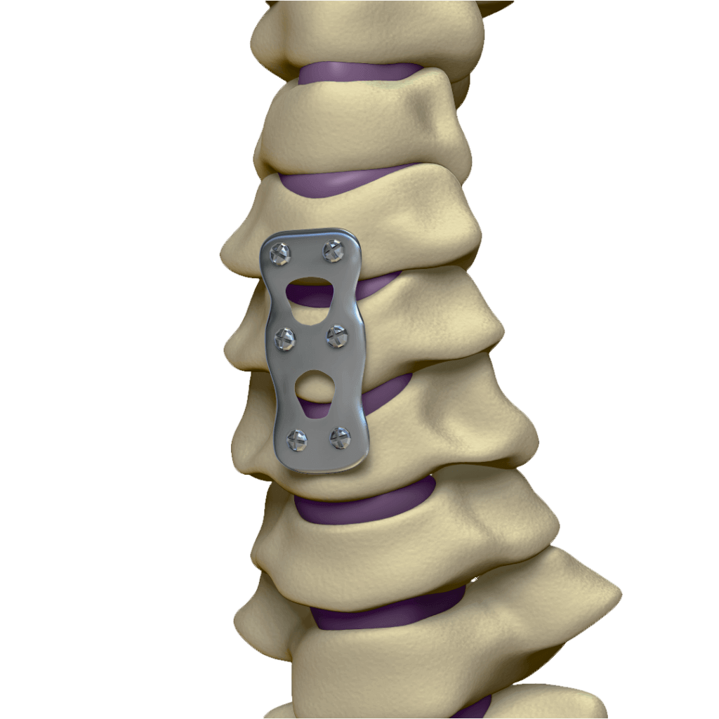 Em que consiste a  irurgia de artrodese? - Neurocirurgião Umuarama