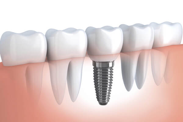 Implante Dentário Ponta Grossa