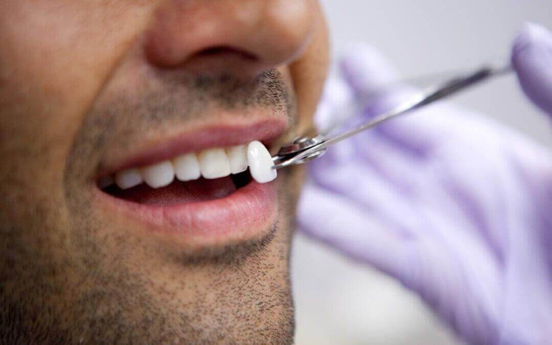 Tratamentos para melhorar a estética do sorriso em Maringá