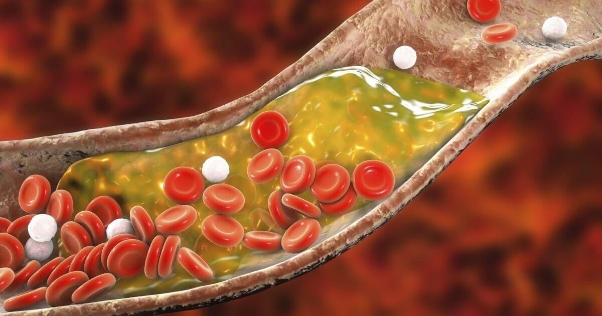 Entenda os riscos do colesterol alto para a sua saúde - Colesterol alto Maringá