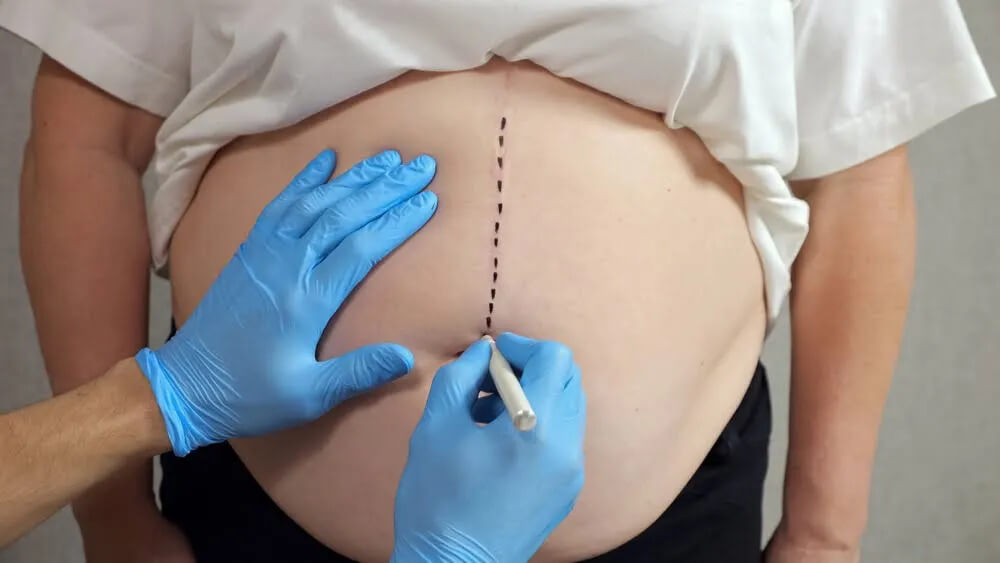 Cirurgia Bariátrica em Curitiba: Técnicas com Dr. Wagner Schiel