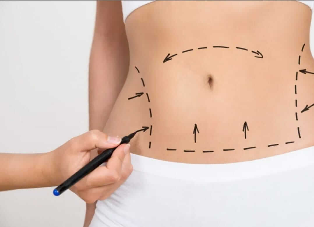 Quais são as principais indicações da abdominoplastia? - Cirurgião Plástico Florianópolis