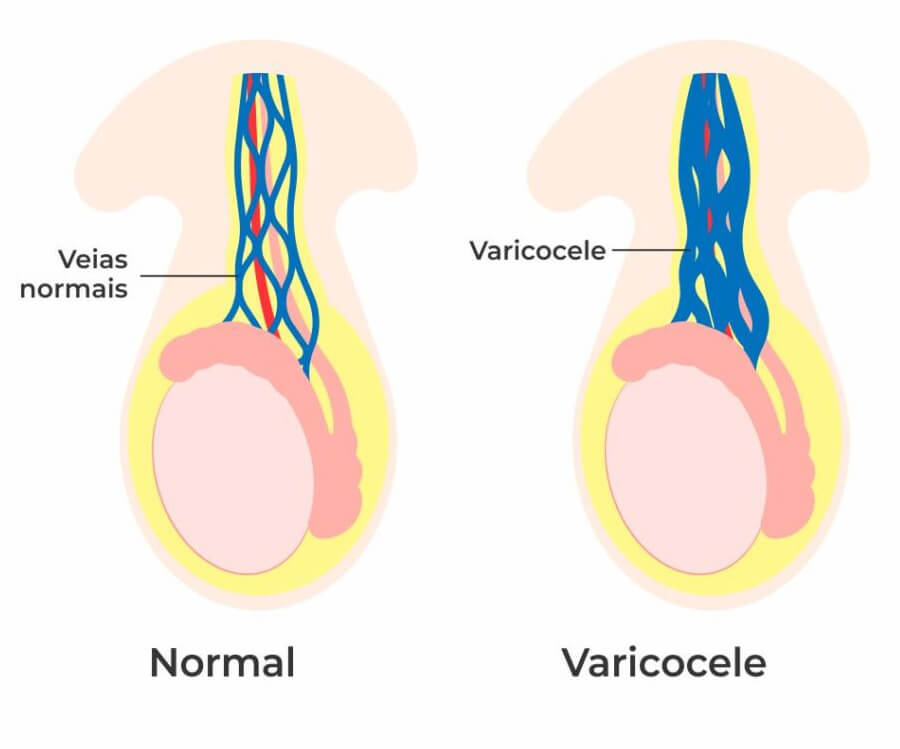 Cirurgia para Varicocele em Salvador