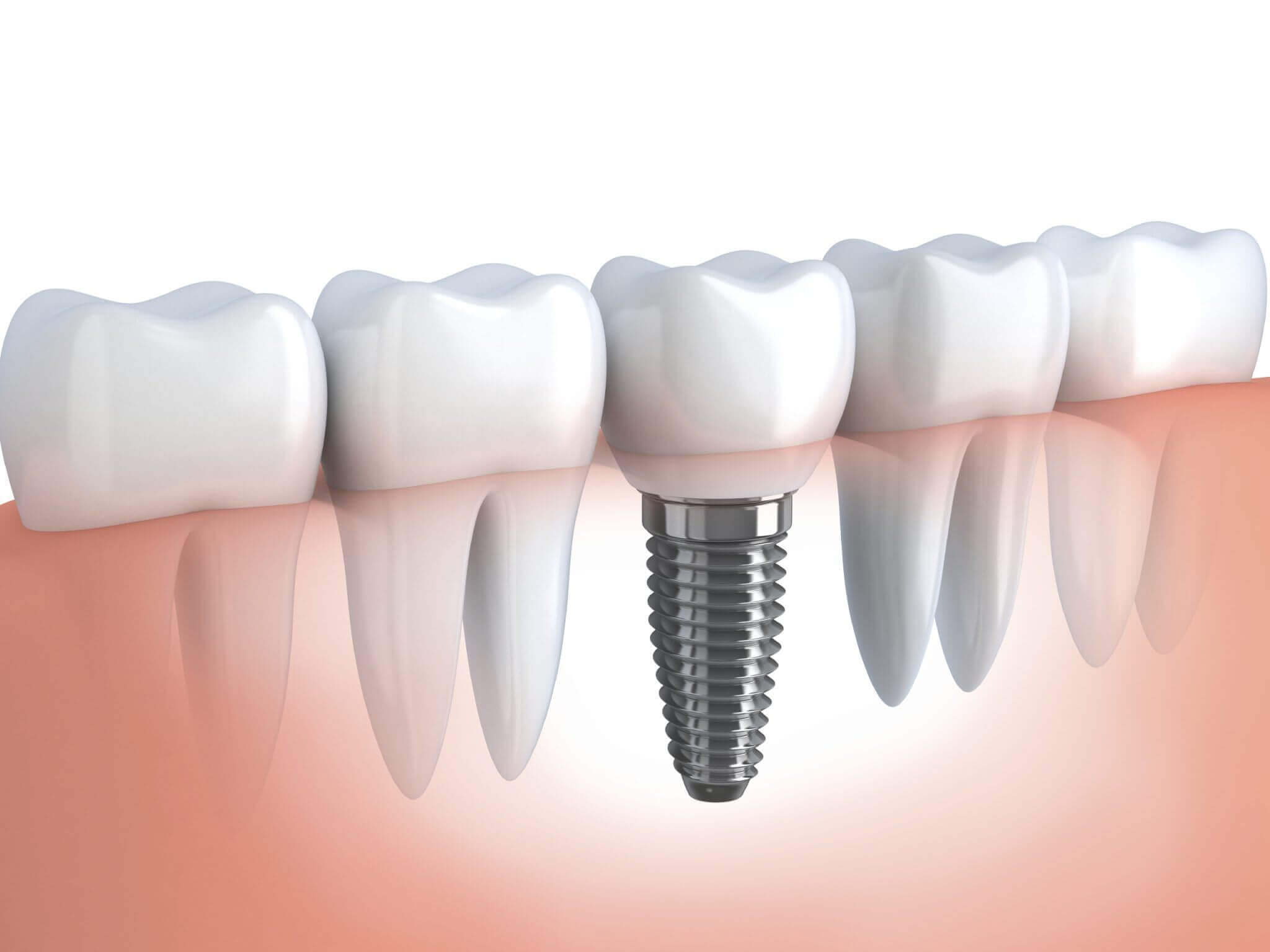 Implante Dentário: O procedimento é seguro? - Implantodontista Maringá