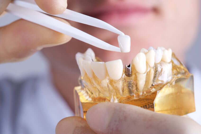 Tratamento com Implante Dentário Maringá: Renove seu Sorriso com Segurança
