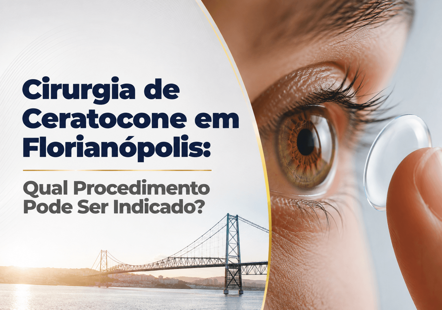 Cirurgia de Ceratocone em Florianópolis: Qual Procedimento Pode Ser Indicado?