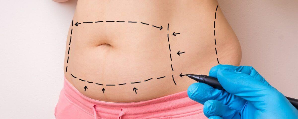 Abdominoplastia: Conheça mais sobre o procedimento e suas indicações - Cirurgião Plástico Guia Saúde