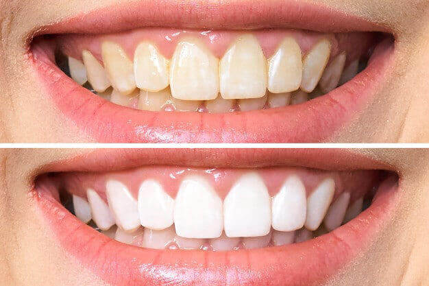 Clareamento Dental Maringá - Sorria com Confiança