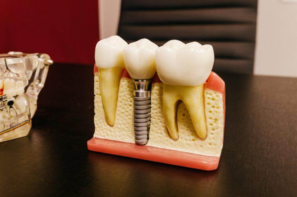 Implantes Dentários Maringá