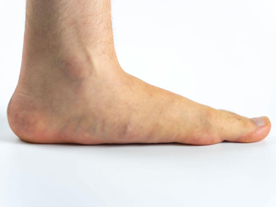 Como corrigir pés planos? - Ortopedista Umuarama