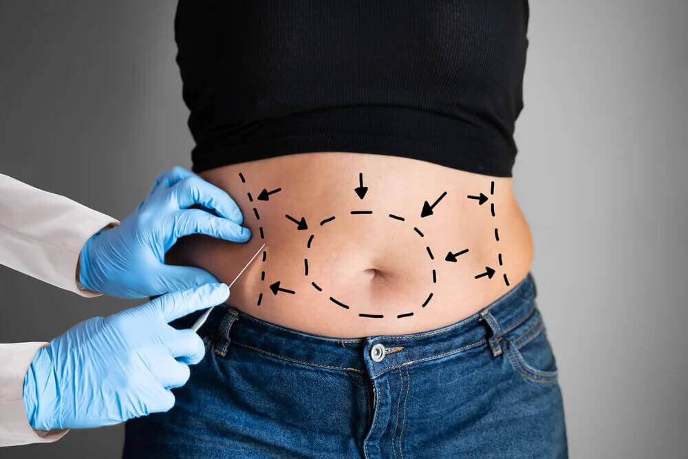 Abdominoplastia Guarujá