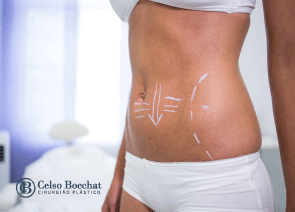 Abdominoplastia - Cirurgia do Abdômen