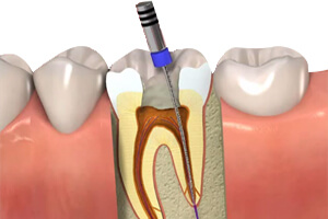 endodontia