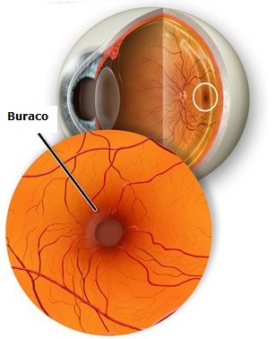 Buraco Macular