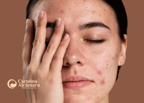 Tratamento de Cicatrizes de Acne