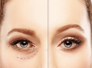  BLEFAROPLASTIA