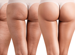 GLUTEOPLASTIA