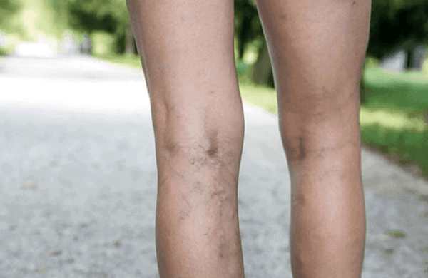 Anticoncepcional pode causar trombose? Especialista em saúde vascular em Londrina explica.