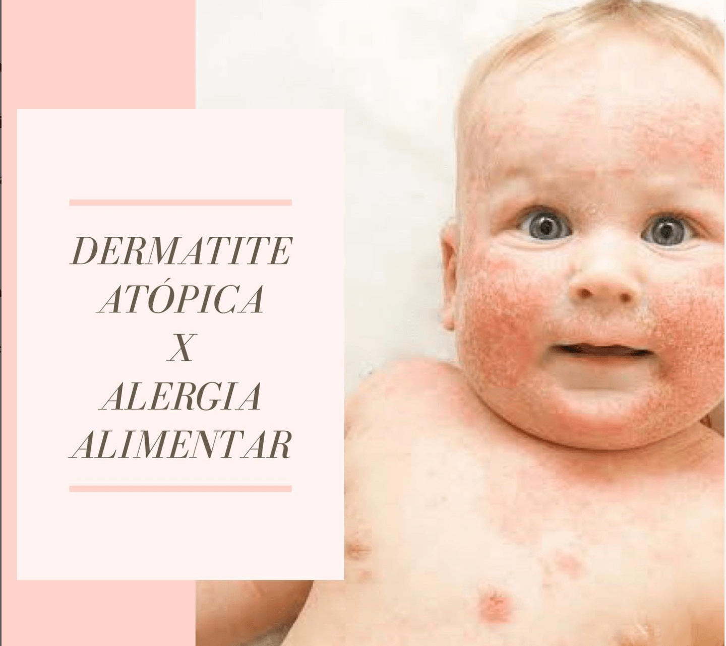 Dermatite atópica X Alergia alimentar