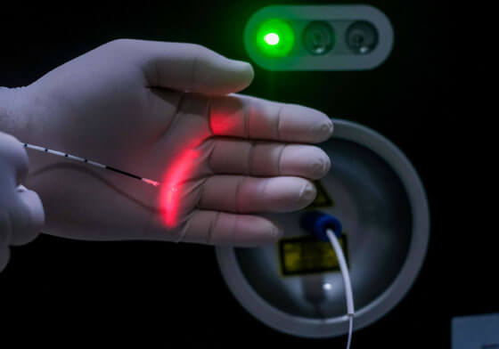 Tratamento de Varizes com Laser Endovenoso.