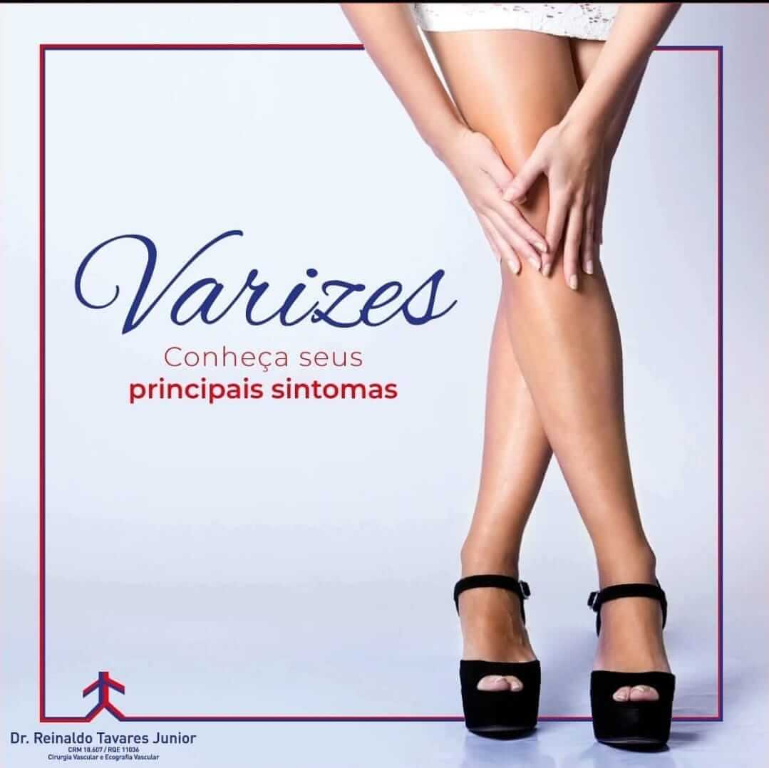 Varizes: Conheça os seus principais sintomas